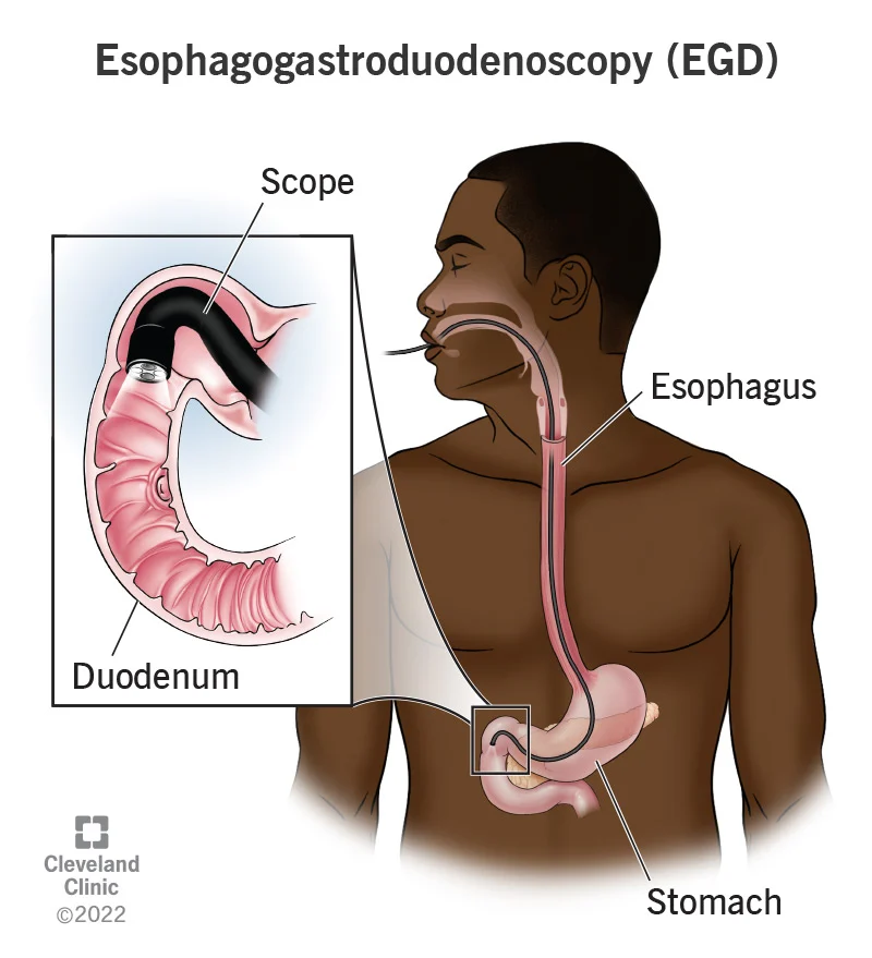esophagogastroduodenoscopy